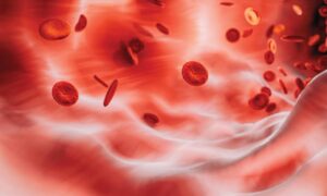 Read more about the article A New Standard Immunosuppression Regimen in Severe Aplastic Anemia