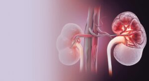 Read more about the article Chronic Kidney Transplant Rejection