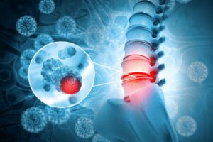 Read more about the article Clonality in immune aplastic anemia: Mechanisms of immune escape or malignant transformation