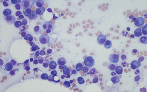 Read more about the article Pericardial Effusion: A Novel Presentation of Aplastic Anemia