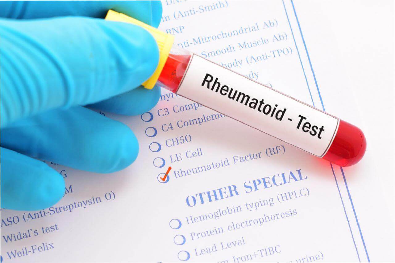 Read more about the article Association Between Novel Hematological Indices and Measures of Disease Activity in Patients with Rheumatoid Arthritis