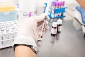 Read more about the article Mass Cytometry Analysis Identifies T Cell Immune Signature of Aplastic Anemia and Predicts the Response to Cyclosporine
