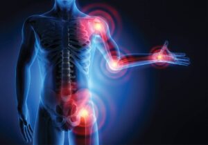 Read more about the article Signaling pathways in rheumatoid arthritis: implications for targeted therapy
