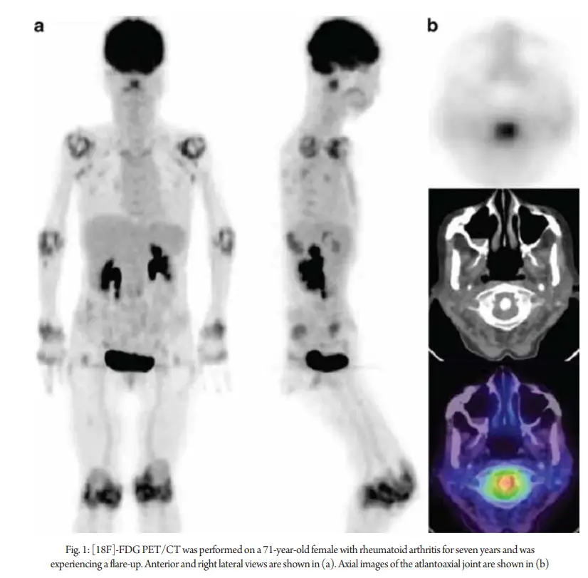 Evolving-role-of-PET-CT-in-the-evaluation