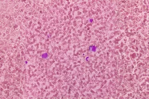 Read more about the article Recent advances in the diagnosis and treatment of pediatric acquired aplastic anemia