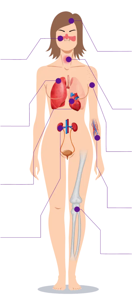 Conquest-Health-Symptoms-Of-Lupus