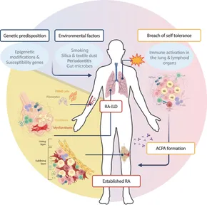 Rheumatoid-arthritis-pathogenesis